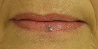 hemangioma plano en adultos hemangioma plano en adultos